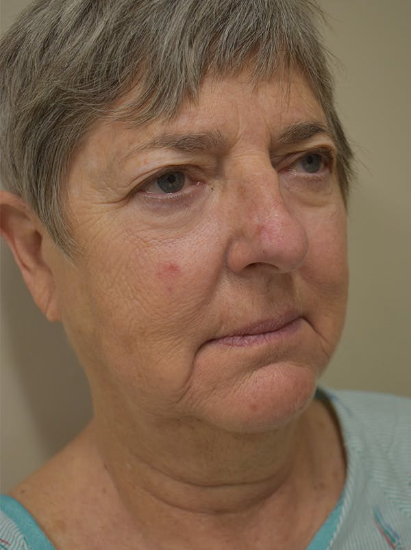 Facelift Before & After Gallery - Patient 106016 - Image 1