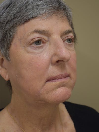 Facelift Before & After Gallery - Patient 106016 - Image 2