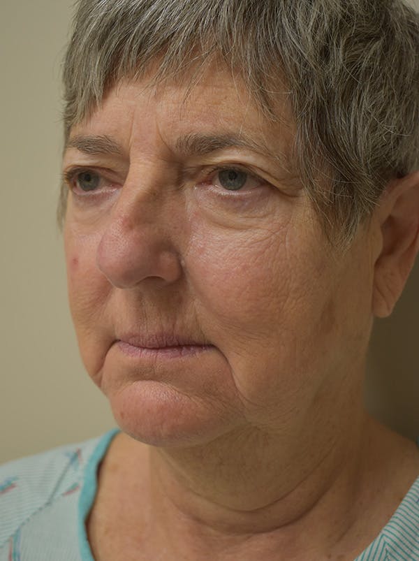 Facelift Before & After Gallery - Patient 106016 - Image 3