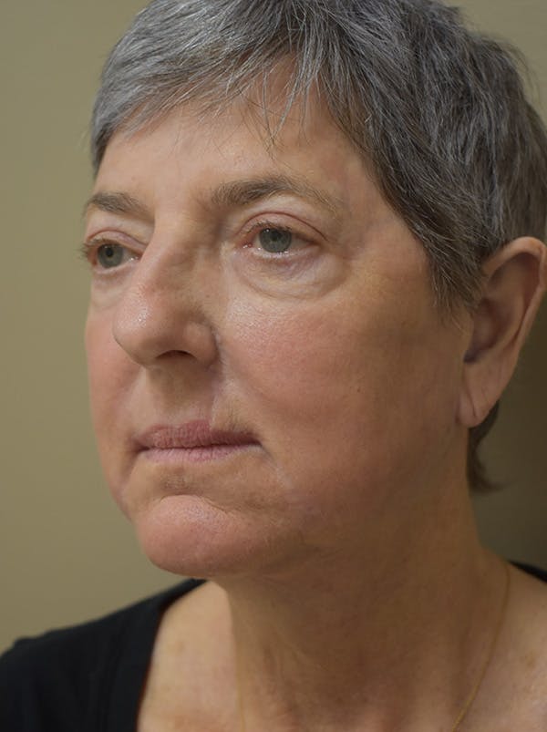 Facelift Before & After Gallery - Patient 106016 - Image 4