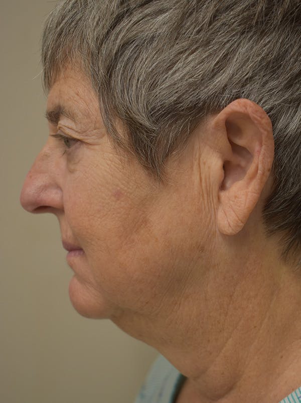 Facelift Before & After Gallery - Patient 106016 - Image 5