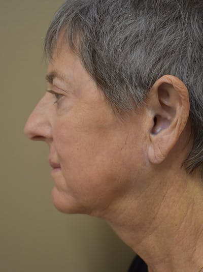 Facelift Before & After Gallery - Patient 106016 - Image 6