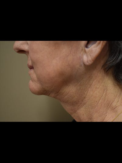 Facelift Before & After Gallery - Patient 106016 - Image 8
