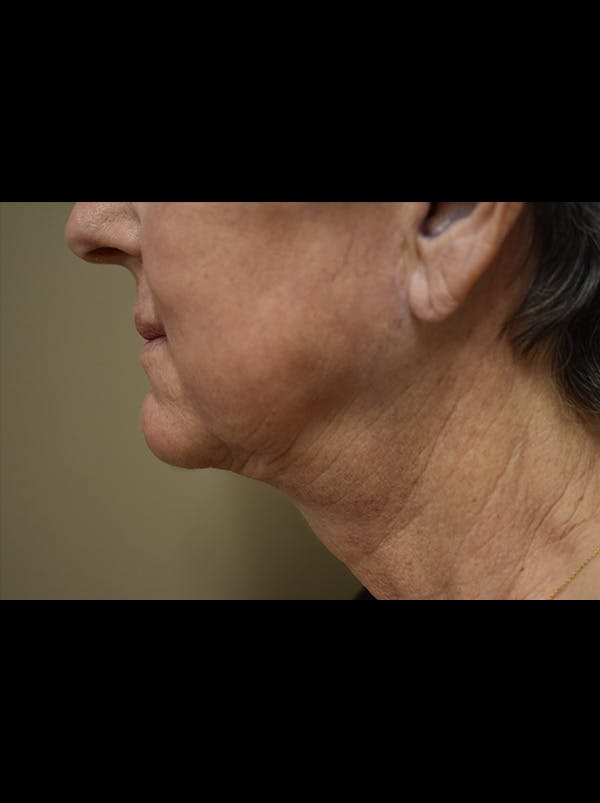 Facelift Before & After Gallery - Patient 106016 - Image 8