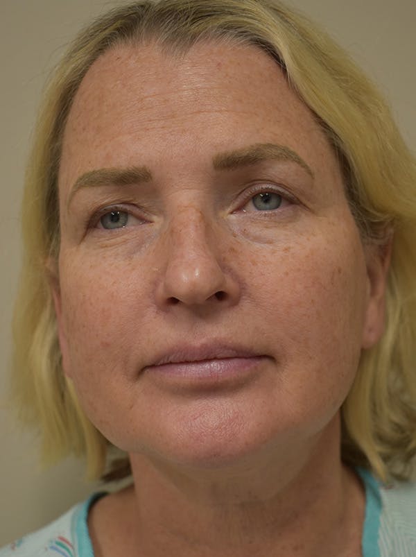 Mini Facelift Before & After Gallery - Patient 253522 - Image 1
