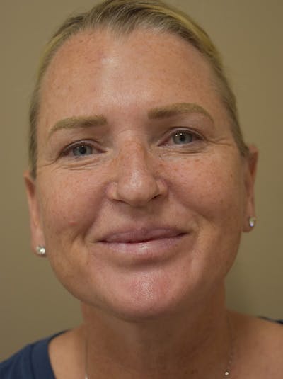 Mini Facelift Before & After Gallery - Patient 253522 - Image 2