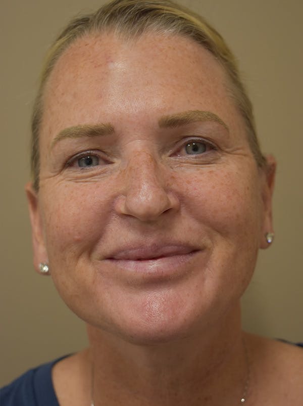 Mini Facelift Before & After Gallery - Patient 253522 - Image 2