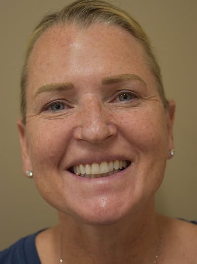 Mini Facelift Before & After Gallery - Patient 253522 - Image 4