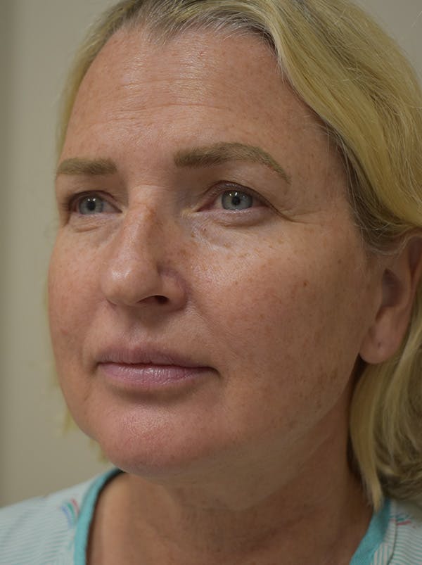Mini Facelift Before & After Gallery - Patient 253522 - Image 5