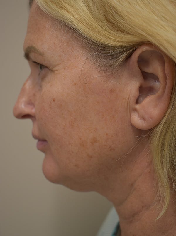 Mini Facelift Before & After Gallery - Patient 253522 - Image 7