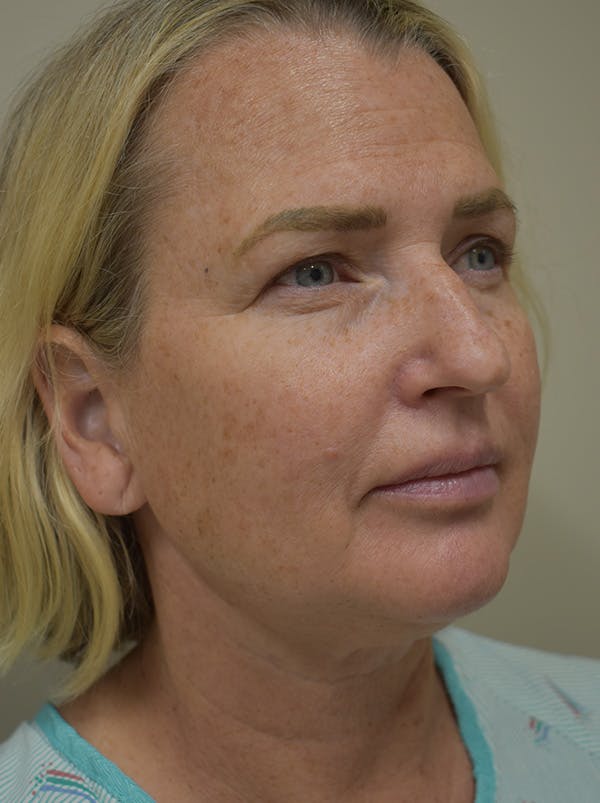 Mini Facelift Before & After Gallery - Patient 253522 - Image 9
