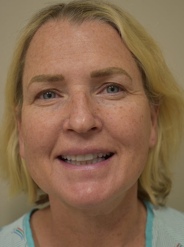 Mini Facelift Before & After Gallery - Patient 253522 - Image 3
