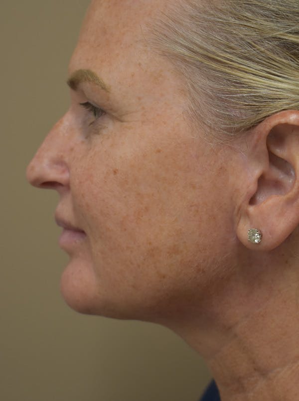 Mini Facelift Before & After Gallery - Patient 253522 - Image 8