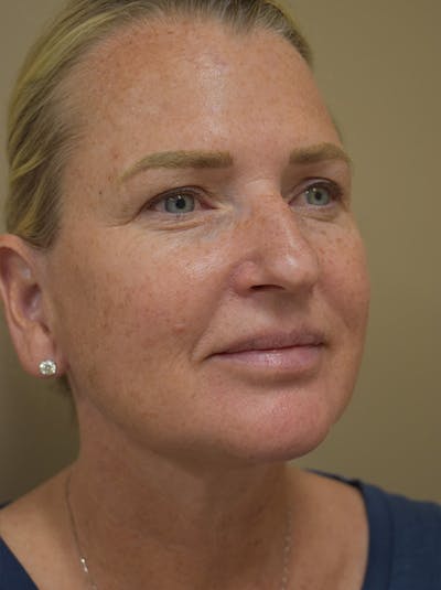 Mini Facelift Before & After Gallery - Patient 253522 - Image 10