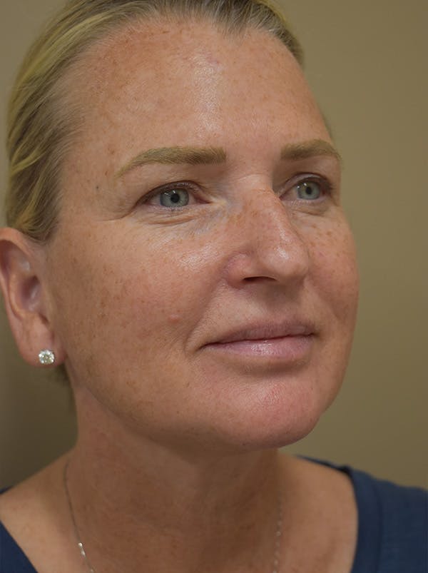 Mini Facelift Before & After Gallery - Patient 253522 - Image 10