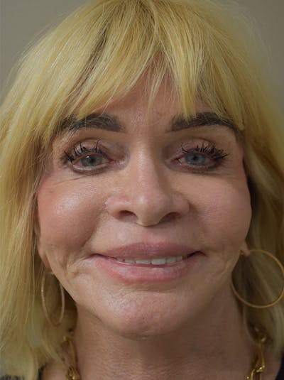 Co2 Laser Resurfacing Before & After Gallery - Patient 176037 - Image 1