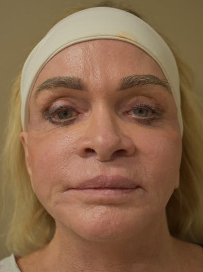 Co2 Laser Resurfacing Before & After Gallery - Patient 176037 - Image 2