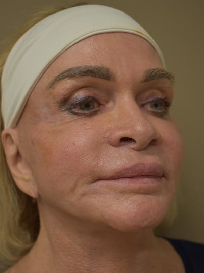 Co2 Laser Resurfacing Before & After Gallery - Patient 176037 - Image 4
