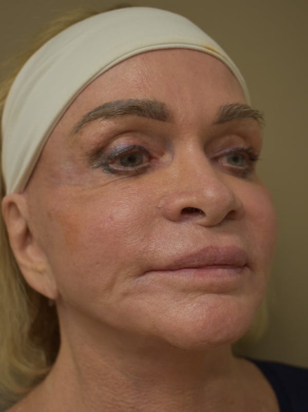 Co2 Laser Resurfacing Before & After Gallery - Patient 176037 - Image 4