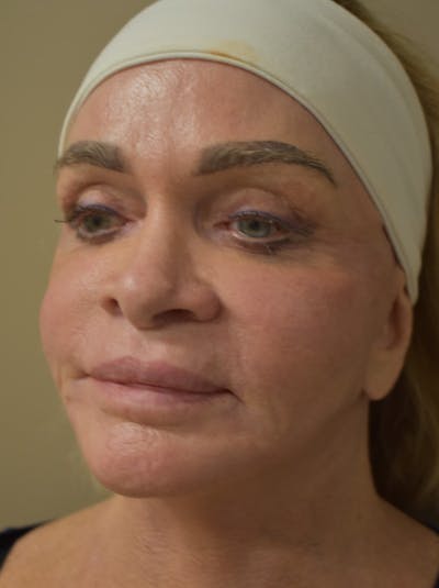Co2 Laser Resurfacing Before & After Gallery - Patient 176037 - Image 6