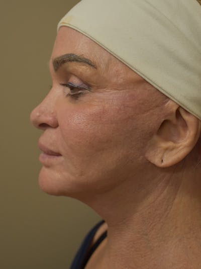 Co2 Laser Resurfacing Before & After Gallery - Patient 176037 - Image 8