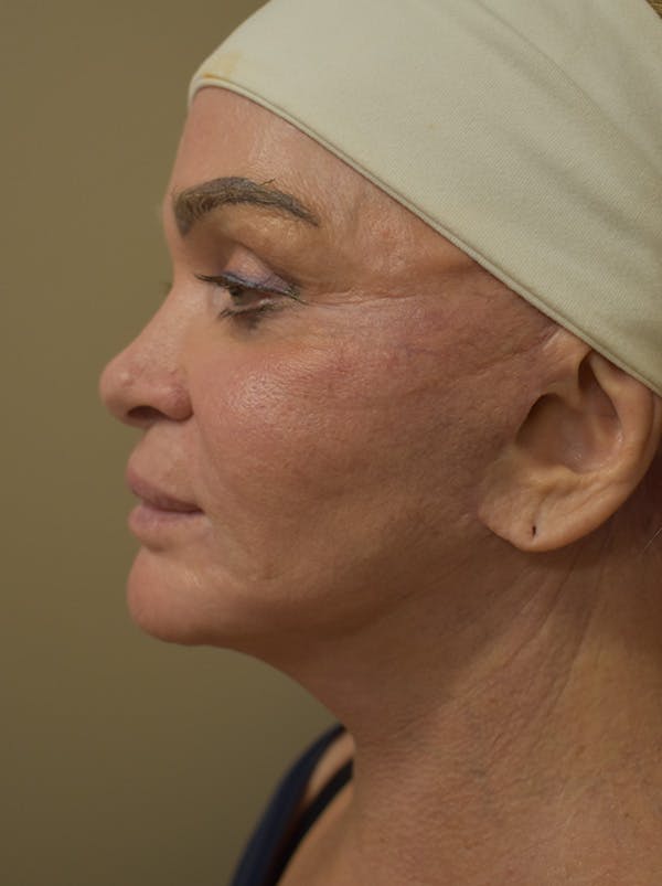 Co2 Laser Resurfacing Before & After Gallery - Patient 176037 - Image 8