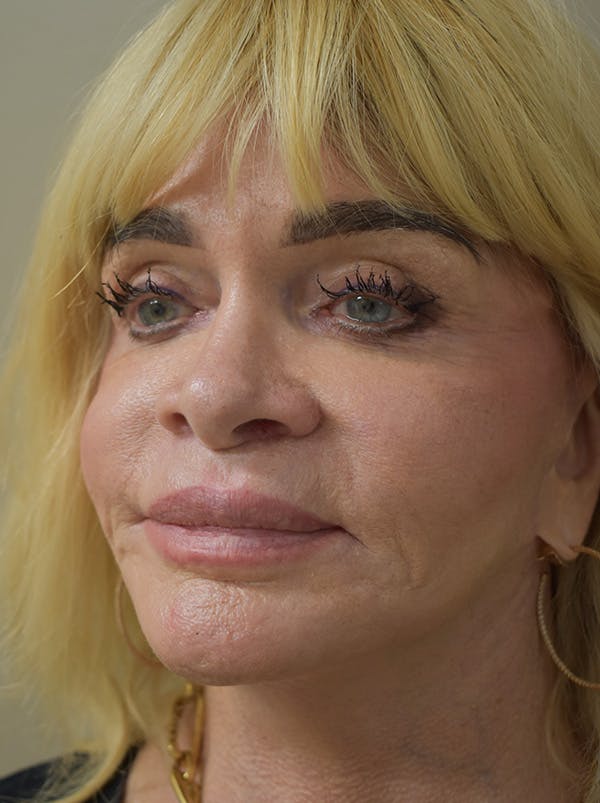 Co2 Laser Resurfacing Before & After Gallery - Patient 176037 - Image 5