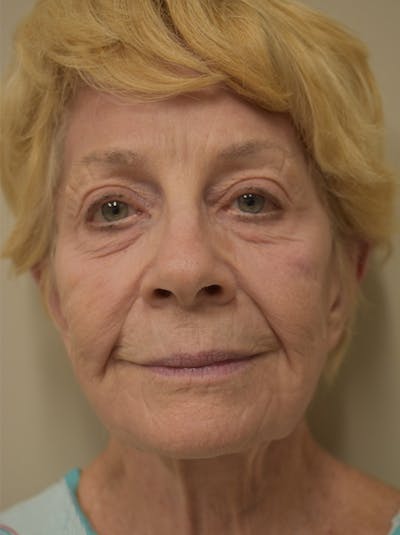 Nasolabial Fold Before & After Gallery - Patient 132833 - Image 1