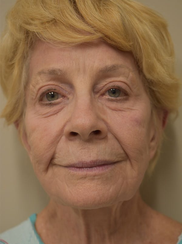 Nasolabial Fold Before & After Gallery - Patient 132833 - Image 1