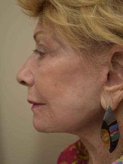 Nasolabial Fold Before & After Gallery - Patient 132833 - Image 6