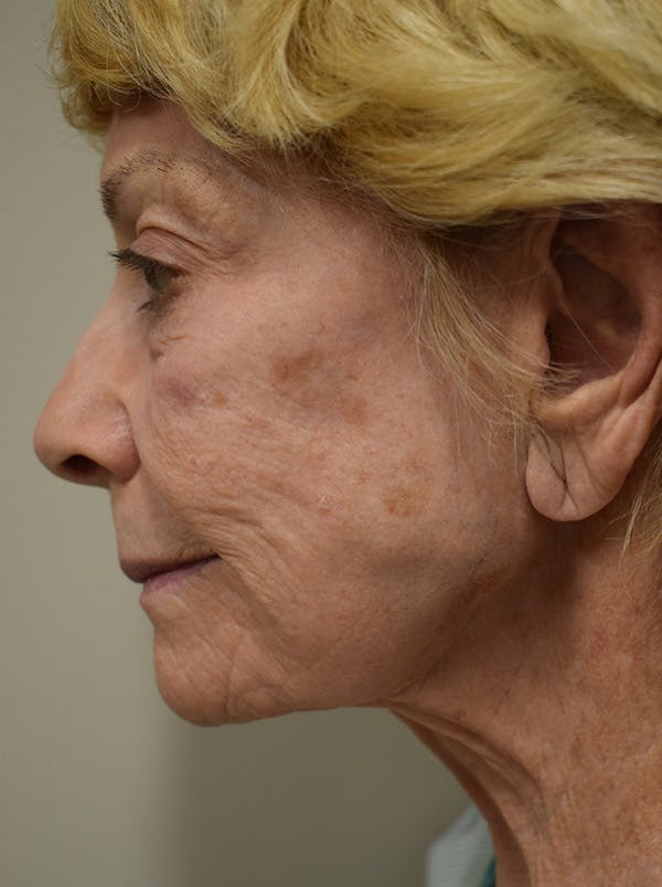 Nasolabial Fold Before & After Gallery - Patient 132833 - Image 5