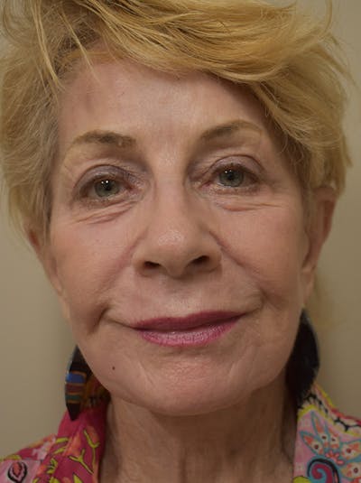 Nasolabial Fold Before & After Gallery - Patient 132833 - Image 2