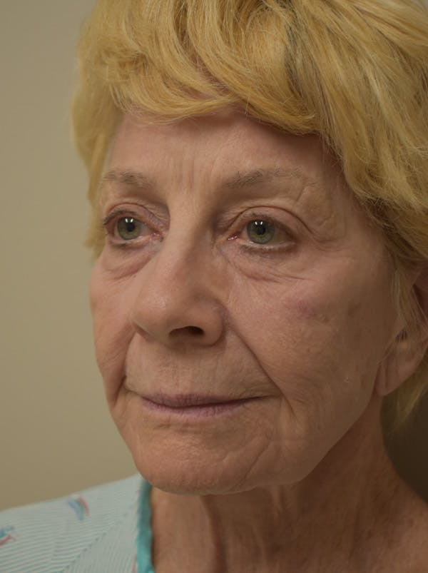 Nasolabial Fold Before & After Gallery - Patient 132833 - Image 3