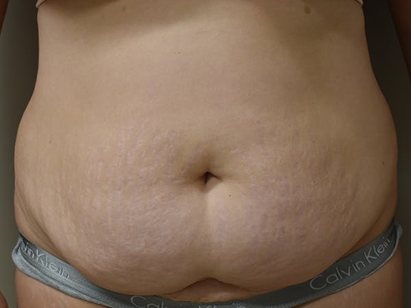 Tummy Tuck Before & After Gallery - Patient 108601 - Image 1