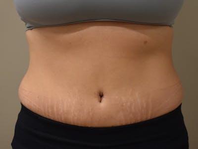 Tummy Tuck Before & After Gallery - Patient 108601 - Image 2