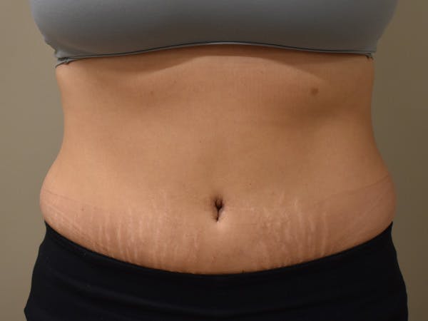 Tummy Tuck Before & After Gallery - Patient 108601 - Image 2