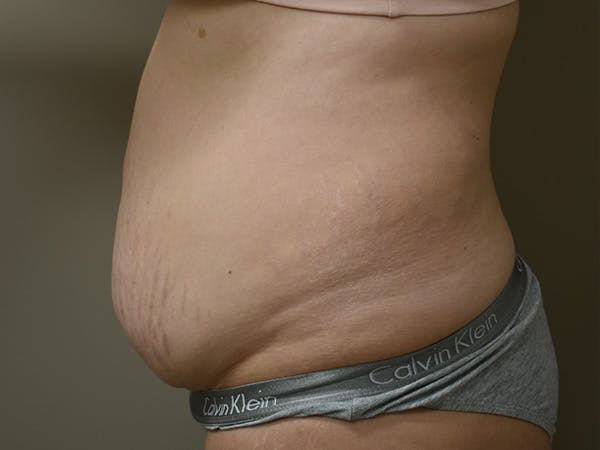 Tummy Tuck Before & After Gallery - Patient 108601 - Image 5