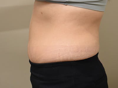 Tummy Tuck Before & After Gallery - Patient 108601 - Image 6