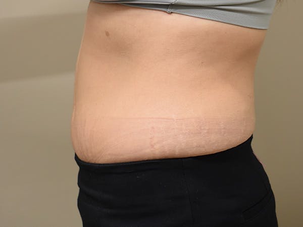 Tummy Tuck Before & After Gallery - Patient 108601 - Image 6