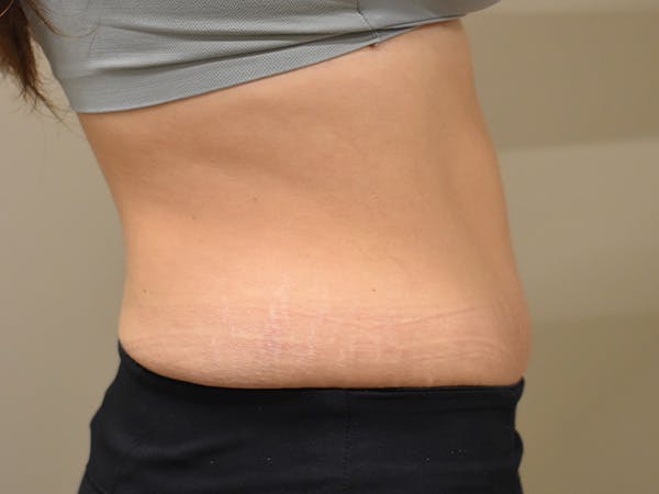 Tummy Tuck Before & After Gallery - Patient 108601 - Image 4