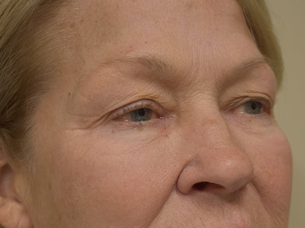 Eyelid Surgery Before & After Gallery - Patient 390918 - Image 3