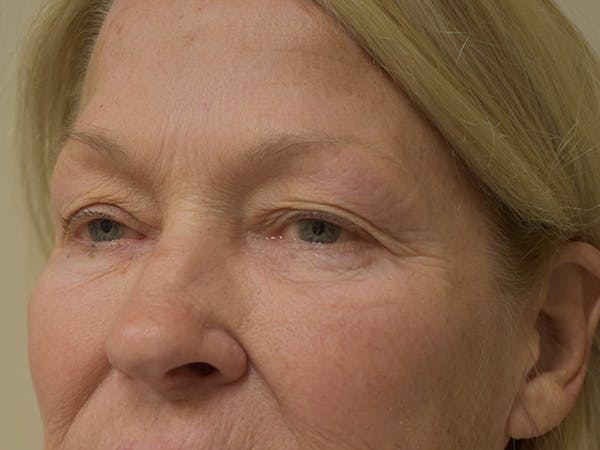 Eyelid Surgery Before & After Gallery - Patient 390918 - Image 5