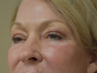 Eyelid Surgery Before & After Gallery - Patient 390918 - Image 6