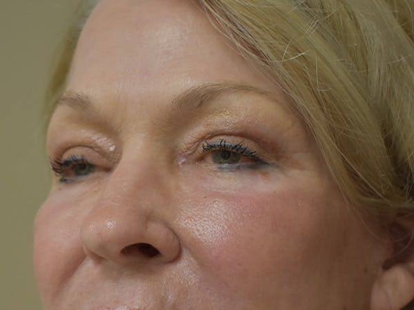 Eyelid Surgery Before & After Gallery - Patient 390918 - Image 6
