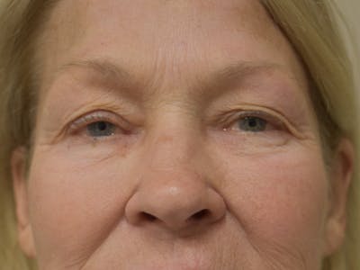 Eyelid Surgery Before & After Gallery - Patient 390918 - Image 1
