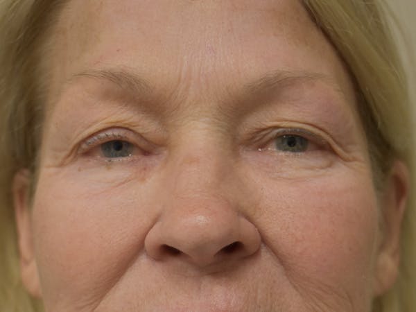 Eyelid Surgery Before & After Gallery - Patient 390918 - Image 1