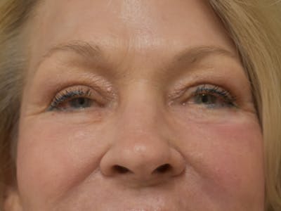 Eyelid Surgery Before & After Gallery - Patient 390918 - Image 2