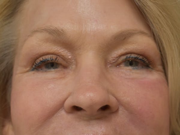 Eyelid Surgery Before & After Gallery - Patient 390918 - Image 2