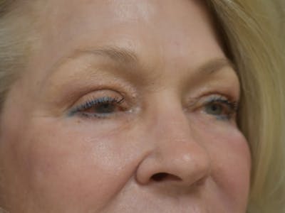 Eyelid Surgery Before & After Gallery - Patient 390918 - Image 4
