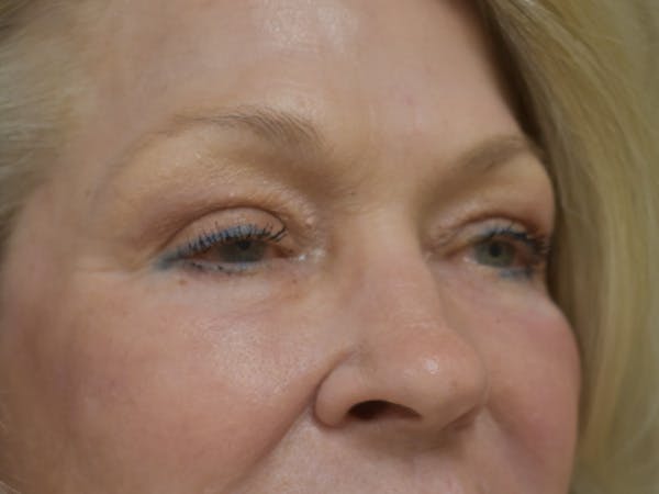Eyelid Surgery Before & After Gallery - Patient 390918 - Image 4